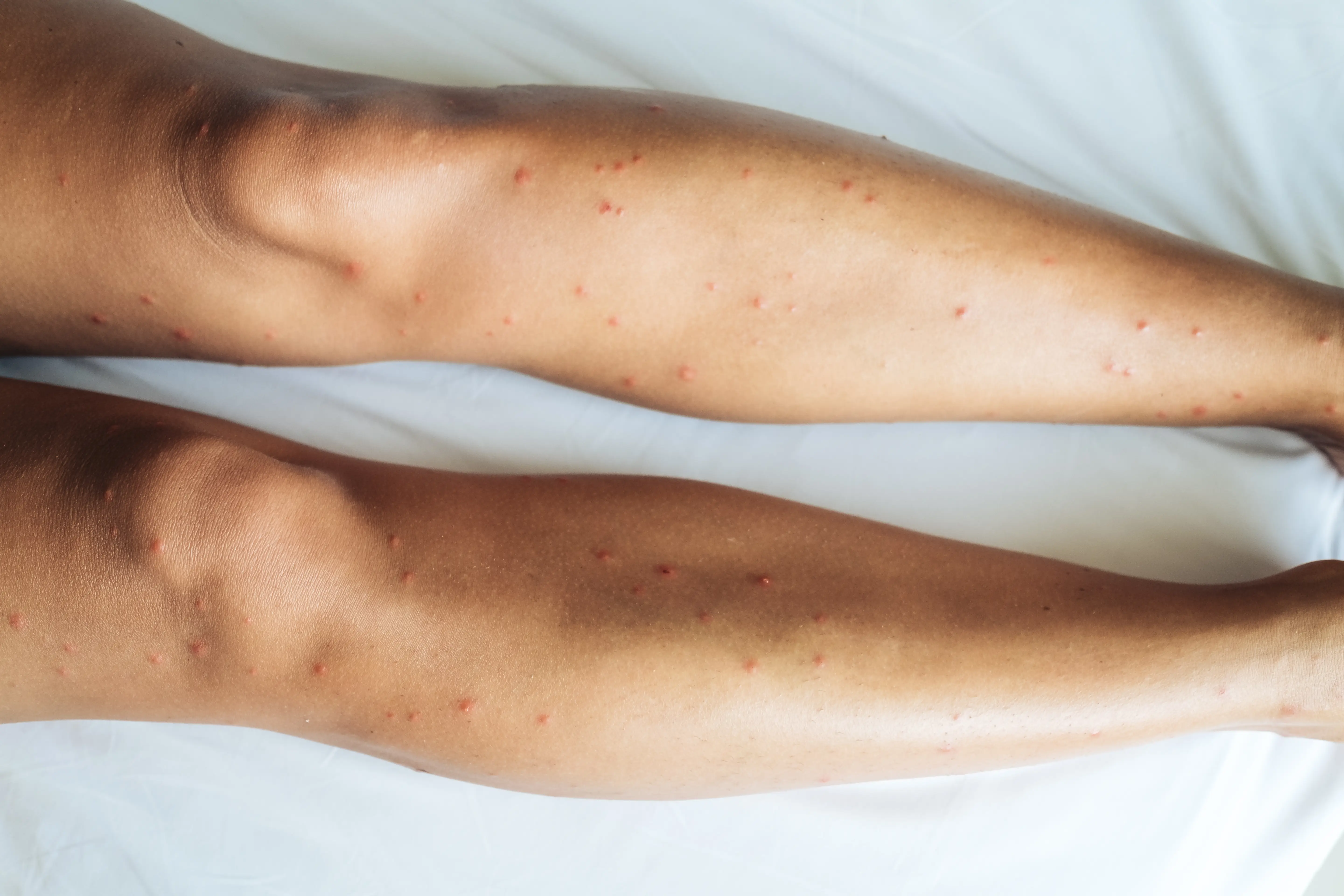 Severe mosquito bite reaction showing swelling and redness